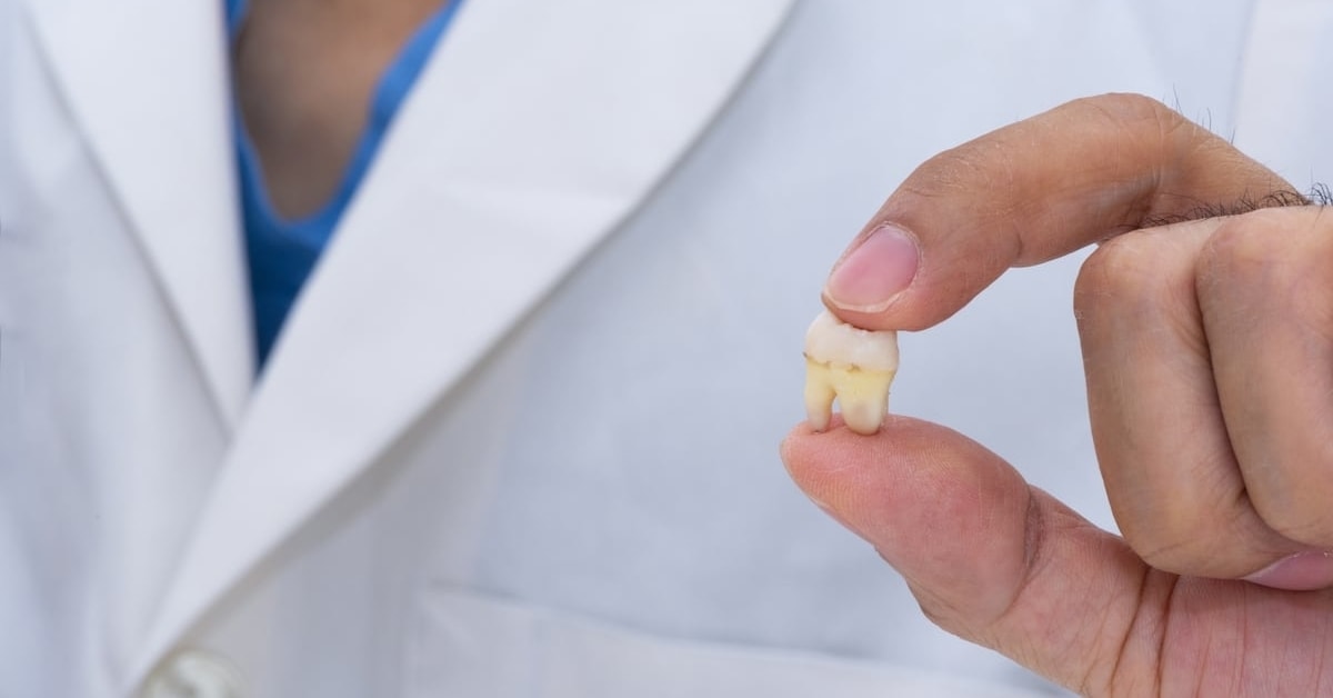 Ask the BayCare Clinic Specialist: Should I have my wisdom teeth removed?