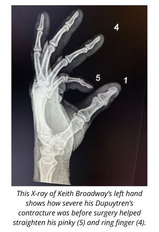 X-ray image of a patient with Dupuytren's contracture.