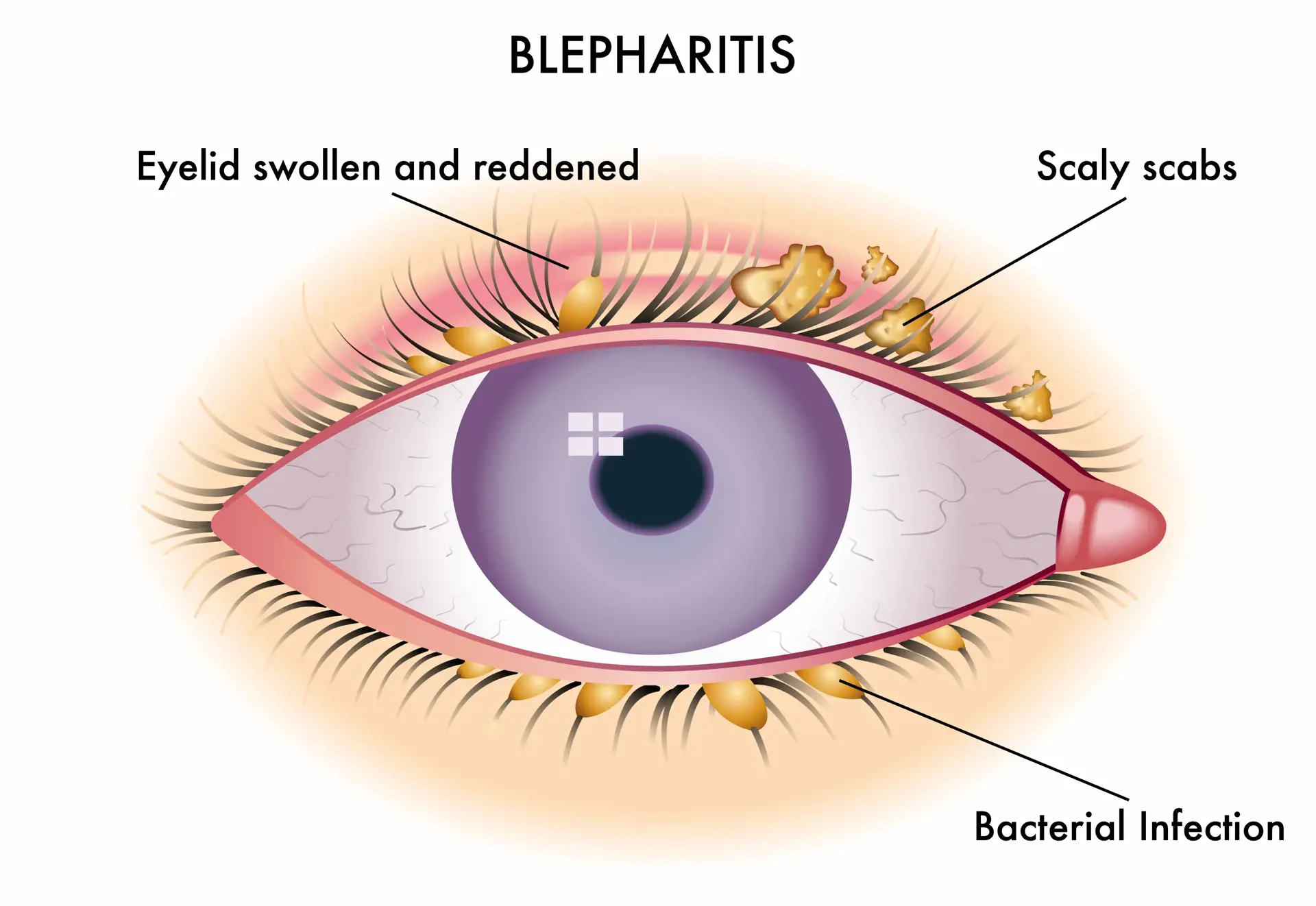Blepharitis Blepharitis